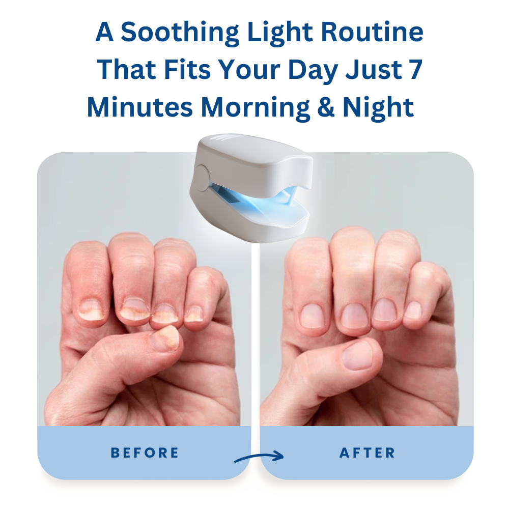 GlowNail - Laser Fungus Remover