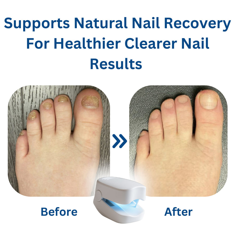 GlowNail - Laser Fungus Remover